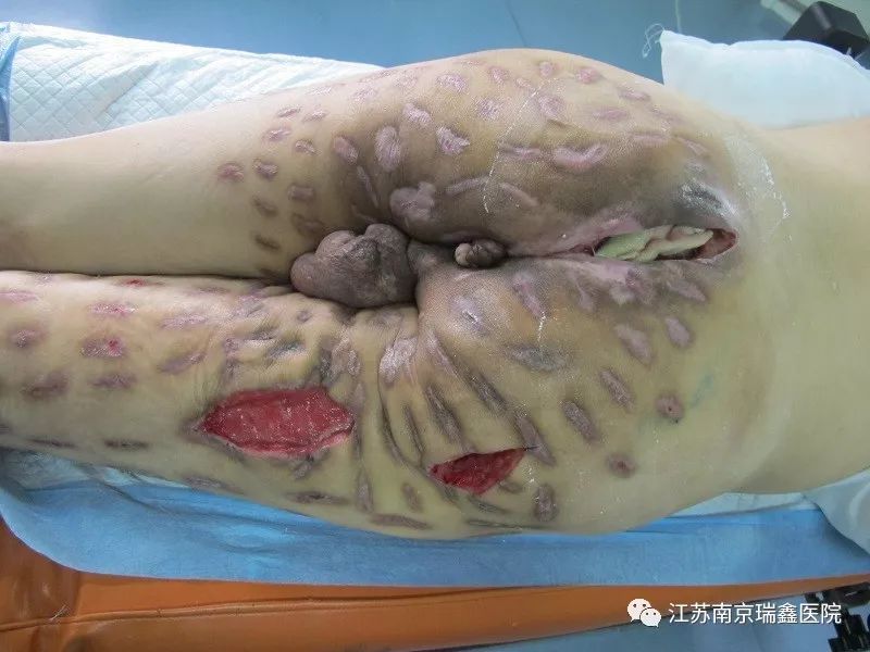 典型案例分析(第二期)——压疮与坏死性筋膜炎