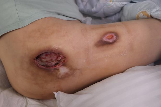 上海市褥疮患者吕某某