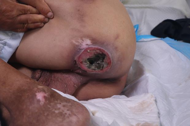 江苏省盐城市褥疮患者沈某某